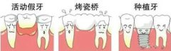 牙齿修复的类型有哪些？
