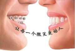 牙齿整形 五种方法