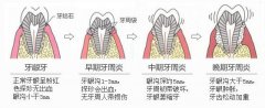 牙体缺损修复的注意事项