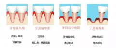 自查“口腔杀手”牙周炎具体该怎么进行