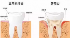 教您判断自己是否出现牙周炎