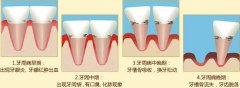 得了牙周炎有可能祸害的是整口牙 你知道吗?