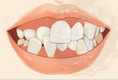 儿童牙齿畸形的防治工作该怎么做？