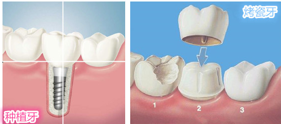 全瓷牙牙体制备过程中易忽视的四大问题