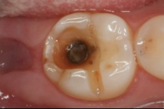 龋齿造成的牙齿缺损怎么办